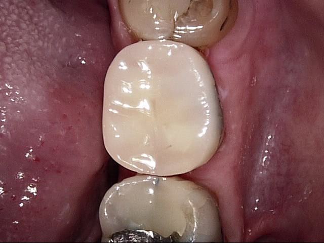 Composite crowns after treatment, Wellington patient at Thorndon Dental