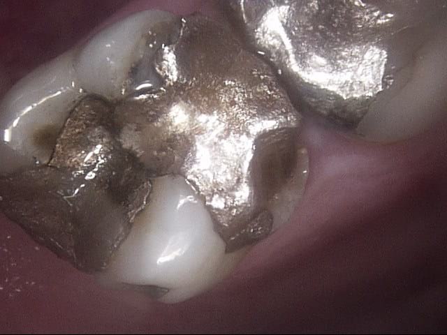 Composite crowns before, Wellington patient at Thorndon Dental