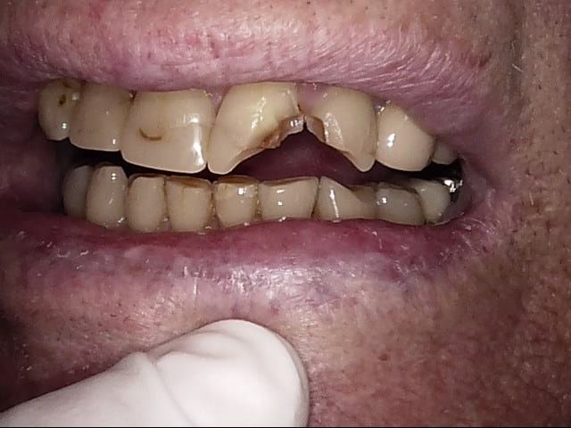 Composite crowns before, Wellington patient at Thorndon Dental