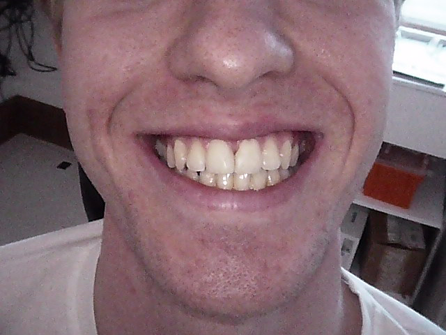 Diastema (gap) closure after, Wellington patient at Thorndon Dental