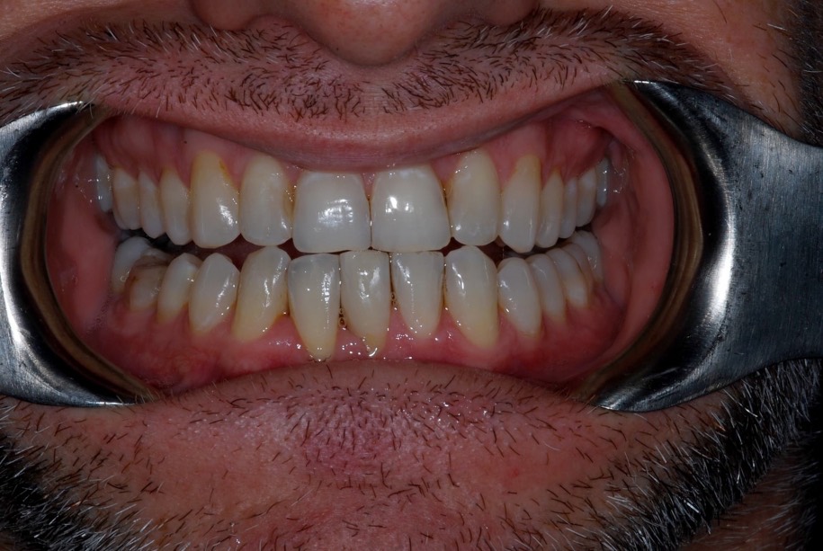 Diastema (gap) closure after, Wellington patient at Thorndon Dental