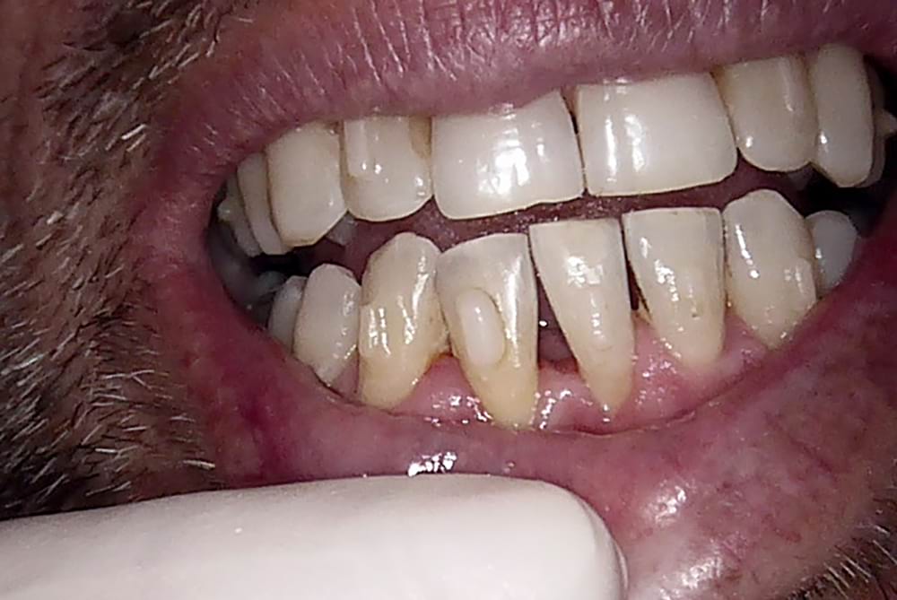 Diastema (gap) closure before, Wellington patient at Thorndon Dental