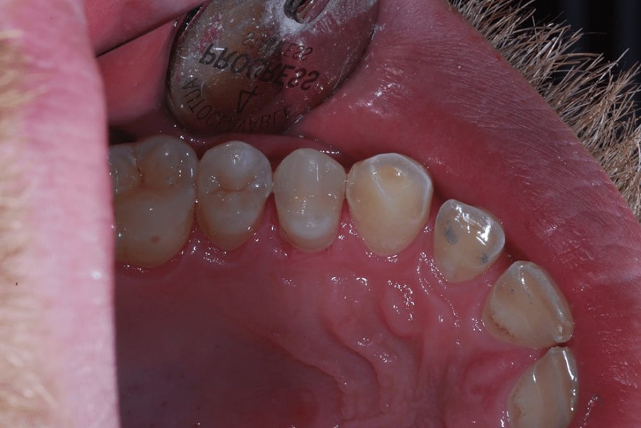 A white composite filling matched to the natural tooth shade, Thorndon Dental patient