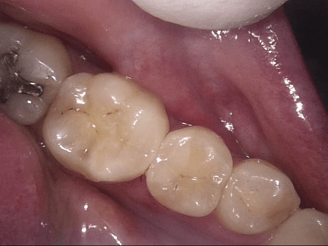 Fillings after, Wellington patient at Thorndon Dental