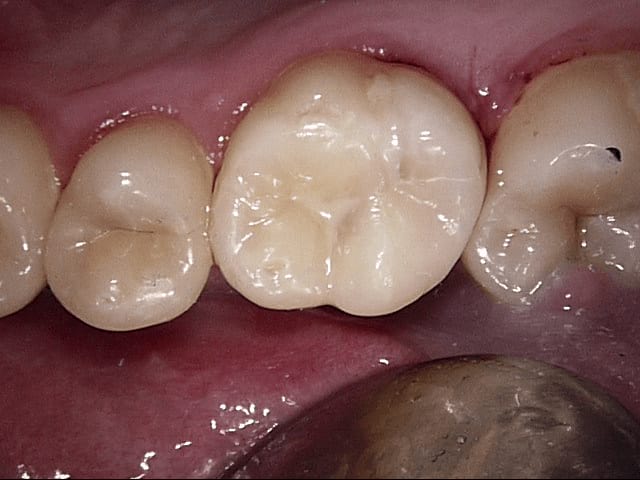 Fillings after, Wellington patient at Thorndon Dental