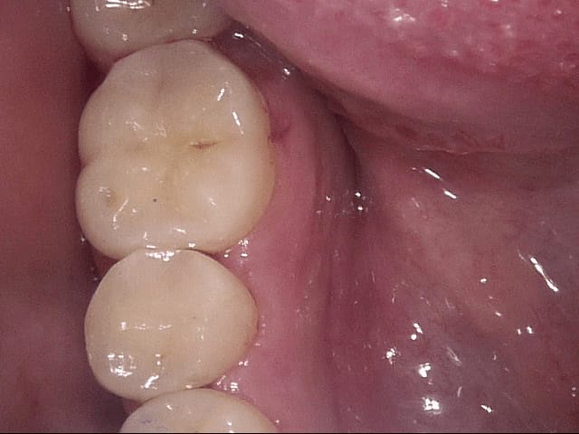 Fillings after, Wellington patient at Thorndon Dental