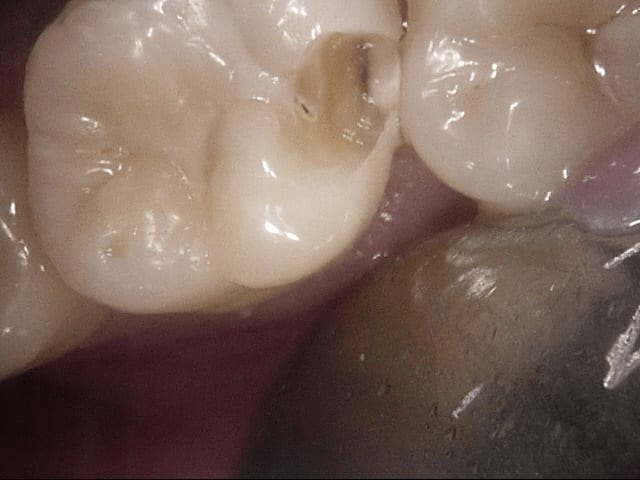 Fillings before, Wellington patient at Thorndon Dental
