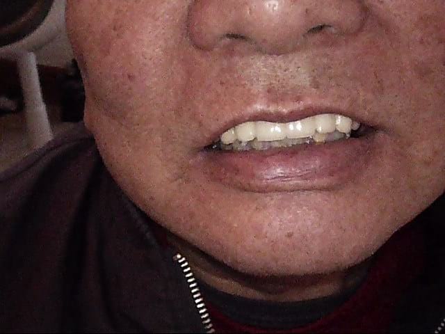 Implants after, Wellington patient at Thorndon Dental