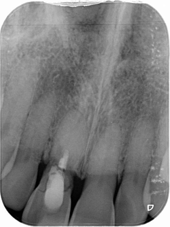 Implants before, Wellington patient at Thorndon Dental