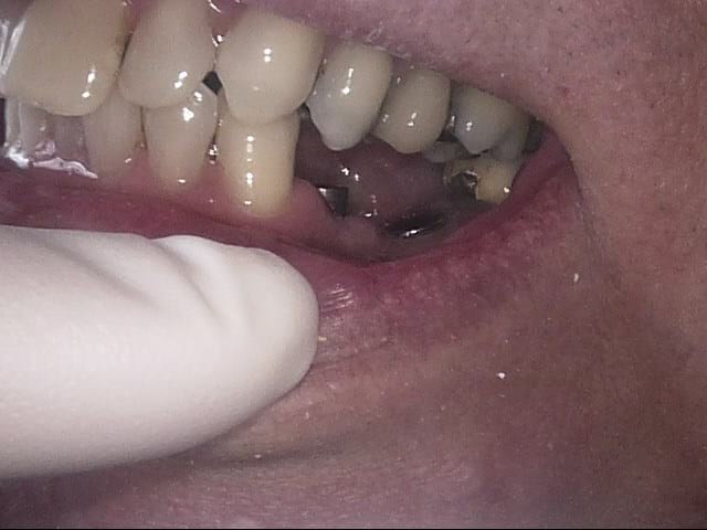 Implants before, Wellington patient at Thorndon Dental