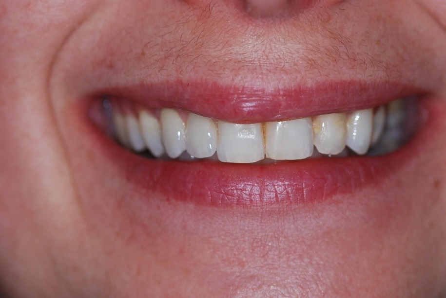 Implants after, Wellington patient at Thorndon Dental