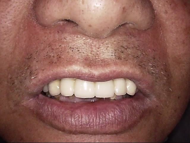 Implants after, Wellington patient at Thorndon Dental