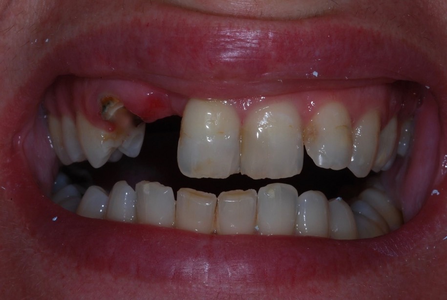 Implants before, Wellington patient at Thorndon Dental