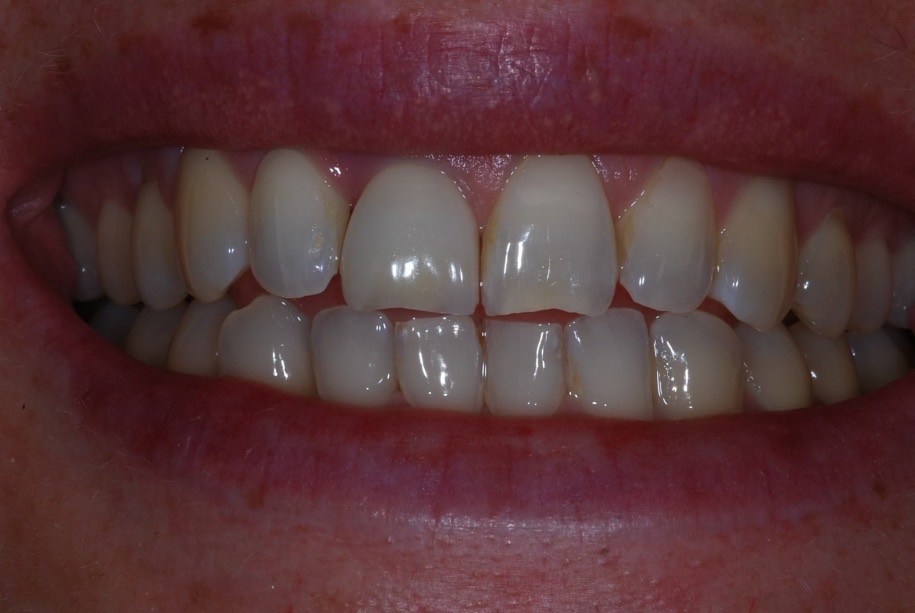 A single tooth implant restored at Thorndon Dental, Wellington
