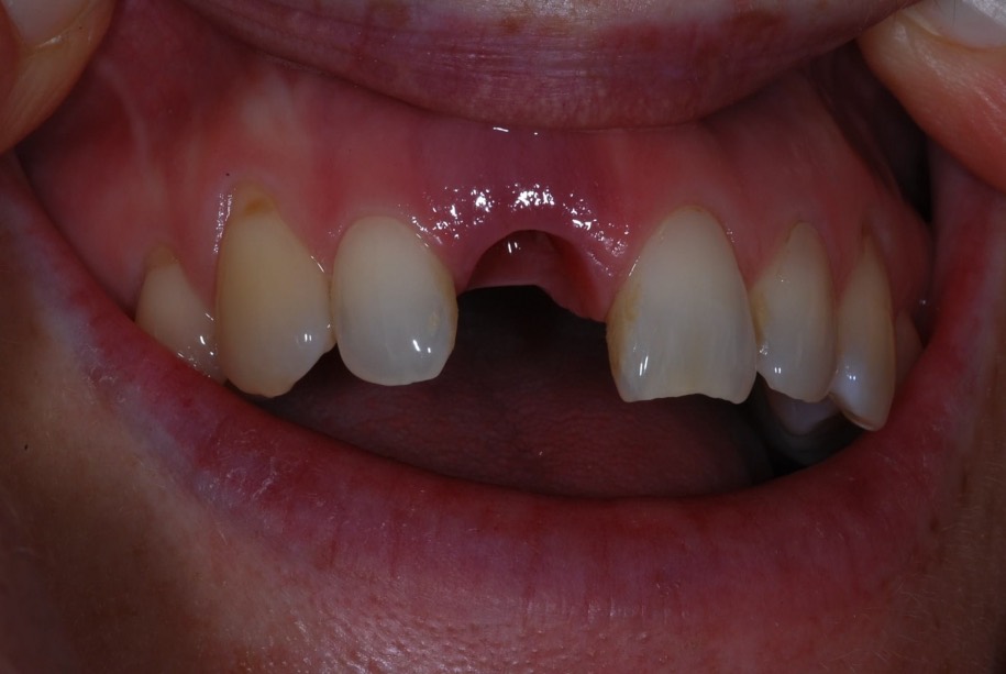 Implants before, Wellington patient at Thorndon Dental