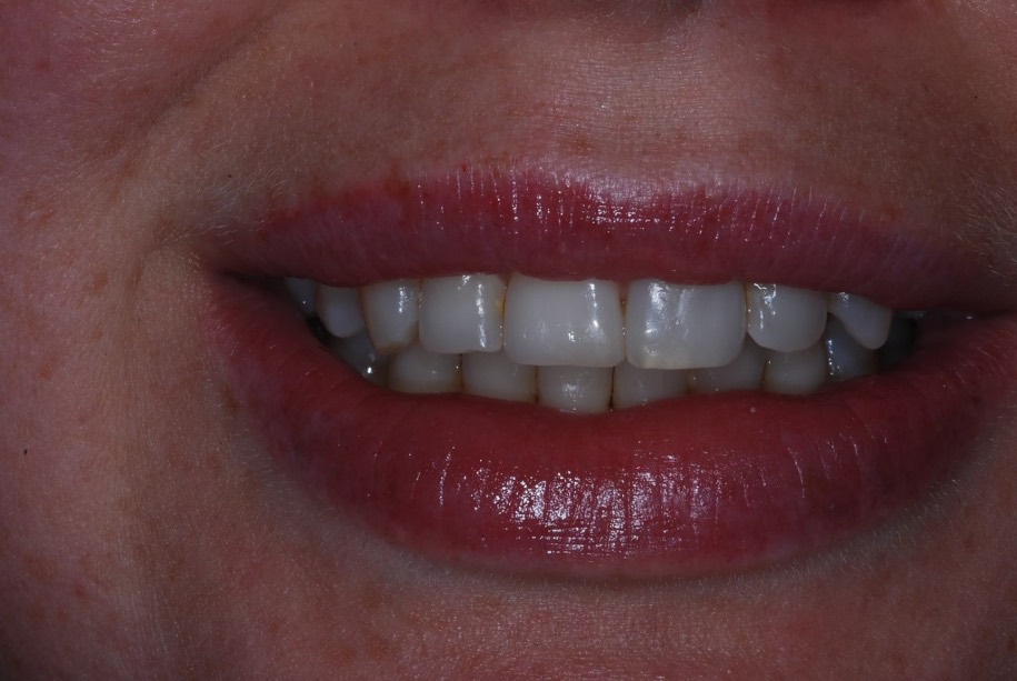 Inman aligner after, Wellington patient at Thorndon Dental