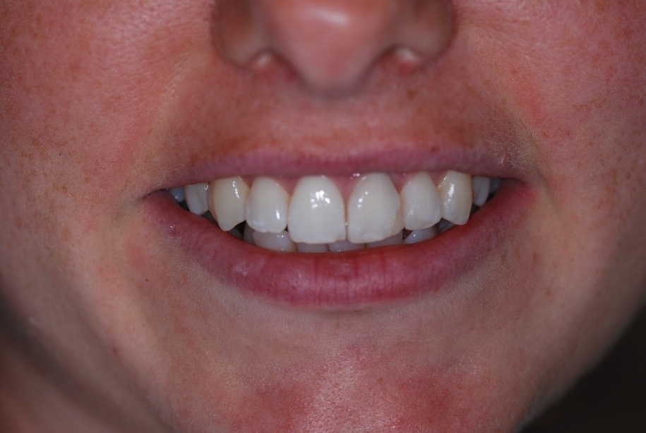 Inman aligner after, Wellington patient at Thorndon Dental