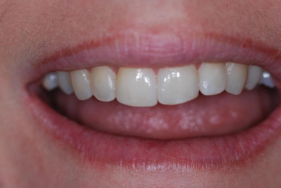 Inman aligner after, Wellington patient at Thorndon Dental