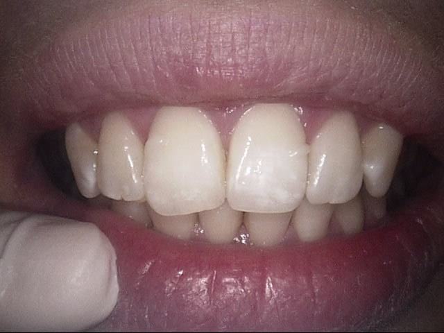 Inman aligner after, Wellington patient at Thorndon Dental