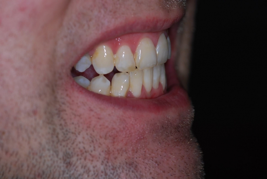Inman aligner after, Wellington patient at Thorndon Dental