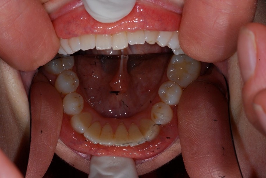 Inman aligner after, Wellington patient at Thorndon Dental