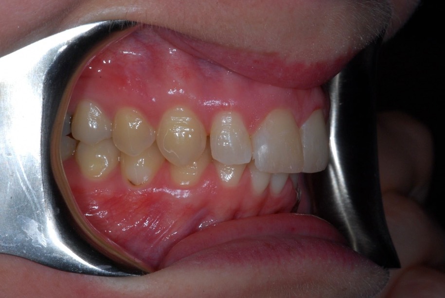 Inman aligner after, Wellington patient at Thorndon Dental
