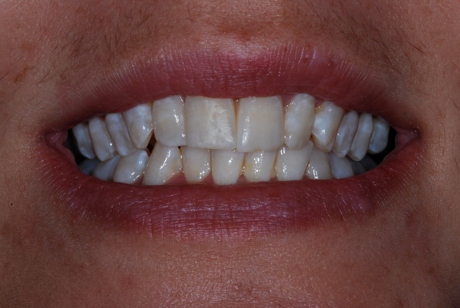 Inman aligner after, Wellington patient at Thorndon Dental