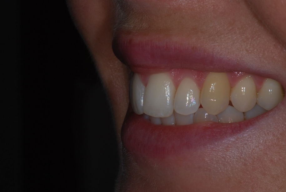 Inman aligner after, Wellington patient at Thorndon Dental