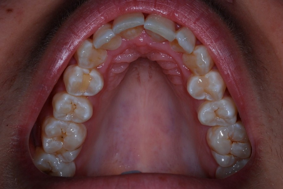 Inman aligner after, Wellington patient at Thorndon Dental