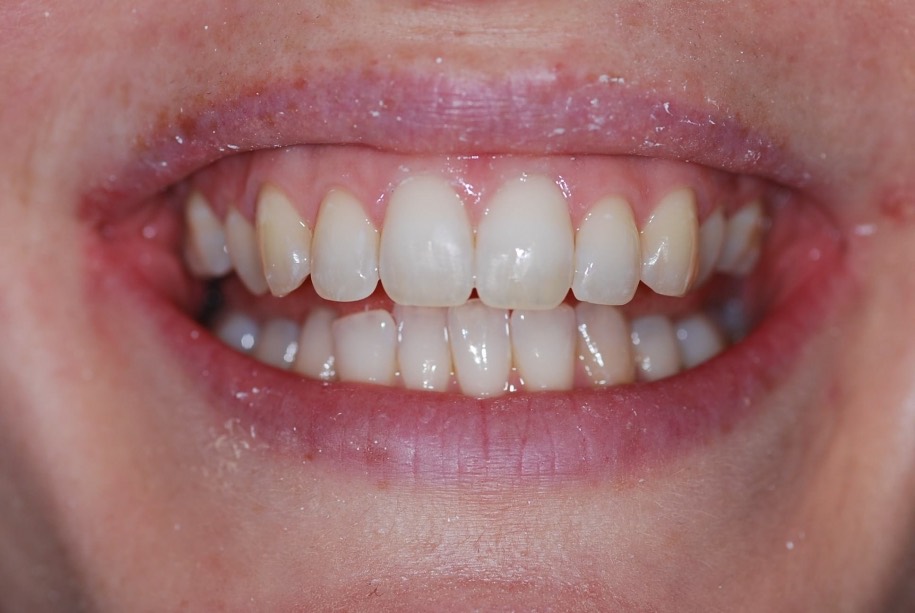 Inman aligner after, Wellington patient at Thorndon Dental