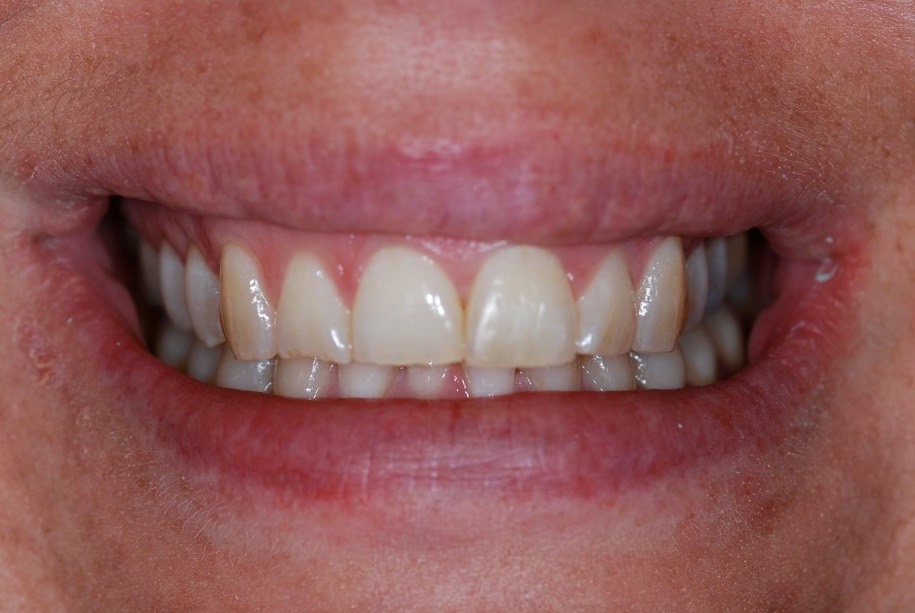 Inman aligner after, Wellington patient at Thorndon Dental