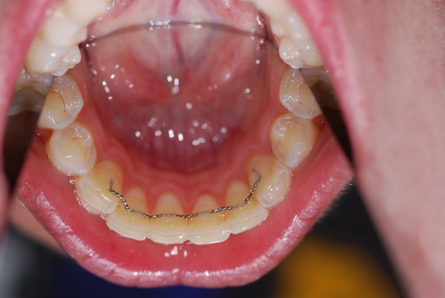 Inman aligner after, Wellington patient at Thorndon Dental