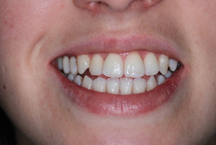 Inman aligner after, Wellington patient at Thorndon Dental