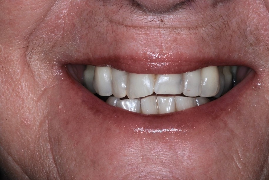 Inman aligner after, Wellington patient at Thorndon Dental
