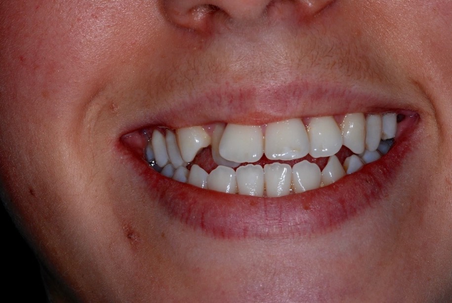 Inman aligner before, Wellington patient at Thorndon Dental