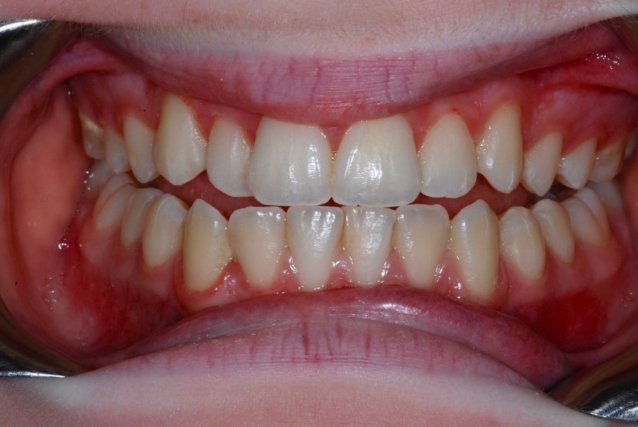 Inman aligner before, Wellington patient at Thorndon Dental