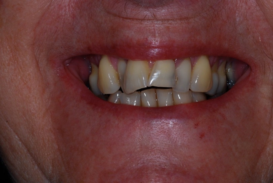 Inman aligner before, Wellington patient at Thorndon Dental