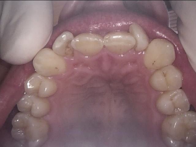 Inman aligner before, Wellington patient at Thorndon Dental