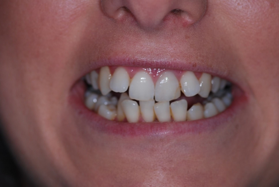 Inman aligner before, Wellington patient at Thorndon Dental