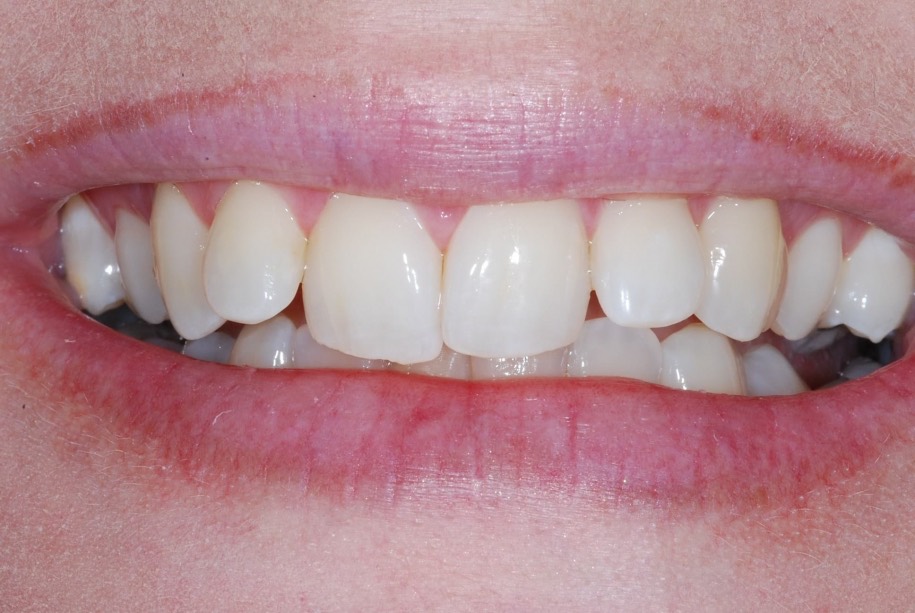 Inman aligner before, Wellington patient at Thorndon Dental