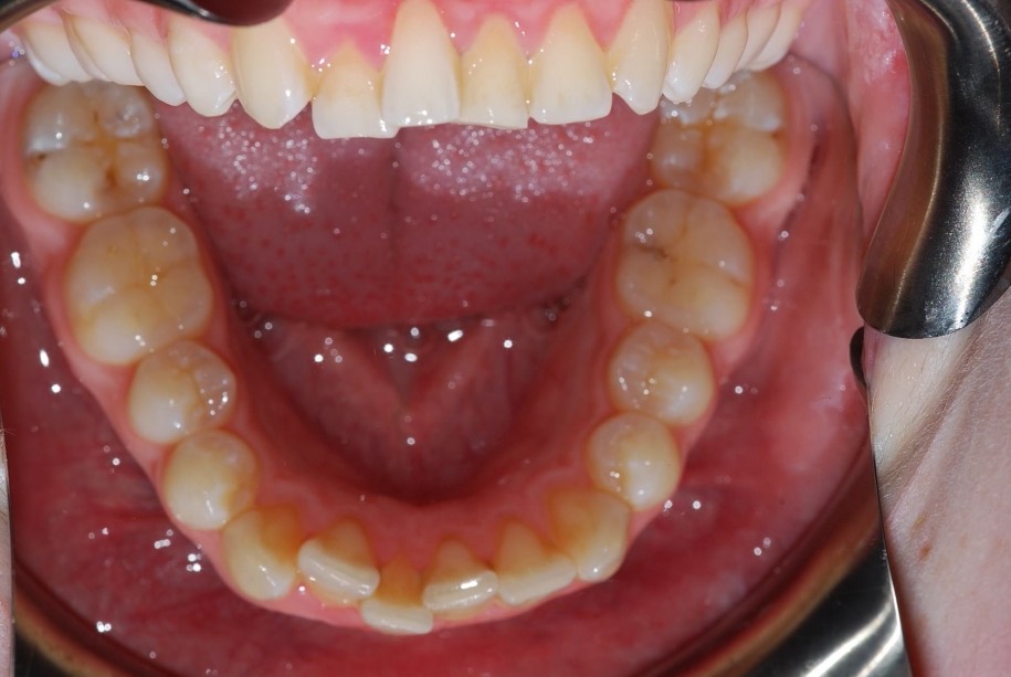 Inman aligner before, Wellington patient at Thorndon Dental