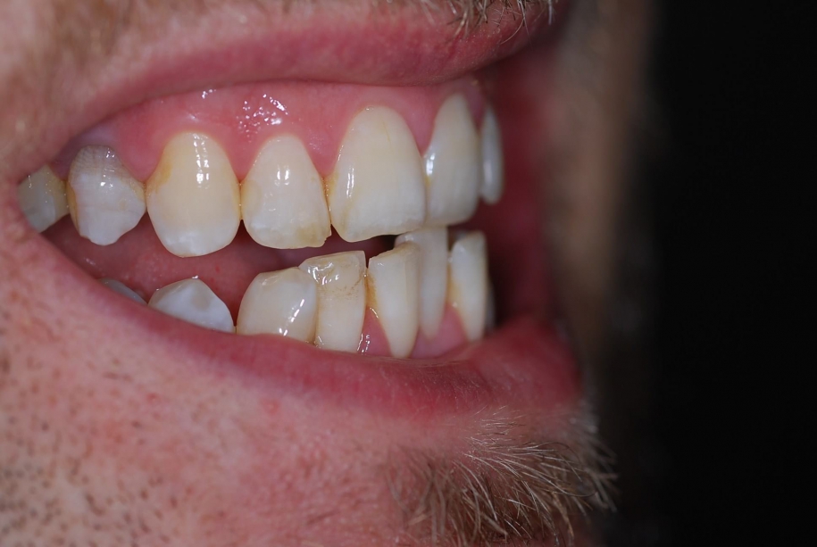 Inman aligner before, Wellington patient at Thorndon Dental