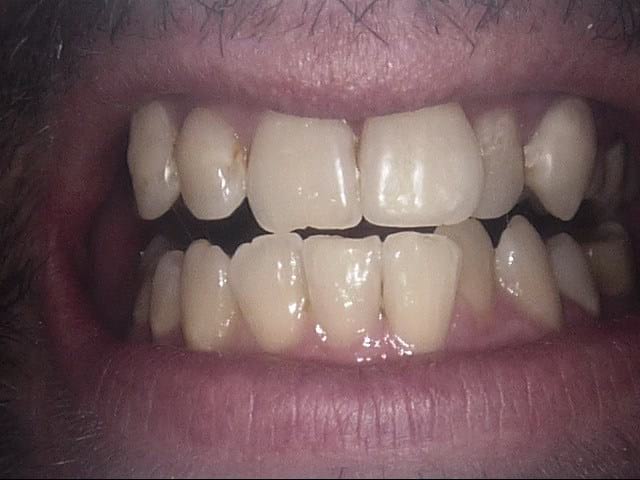 Inman aligner before, Wellington patient at Thorndon Dental