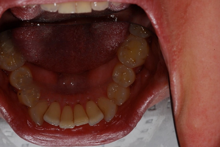 Inman aligner before, Wellington patient at Thorndon Dental
