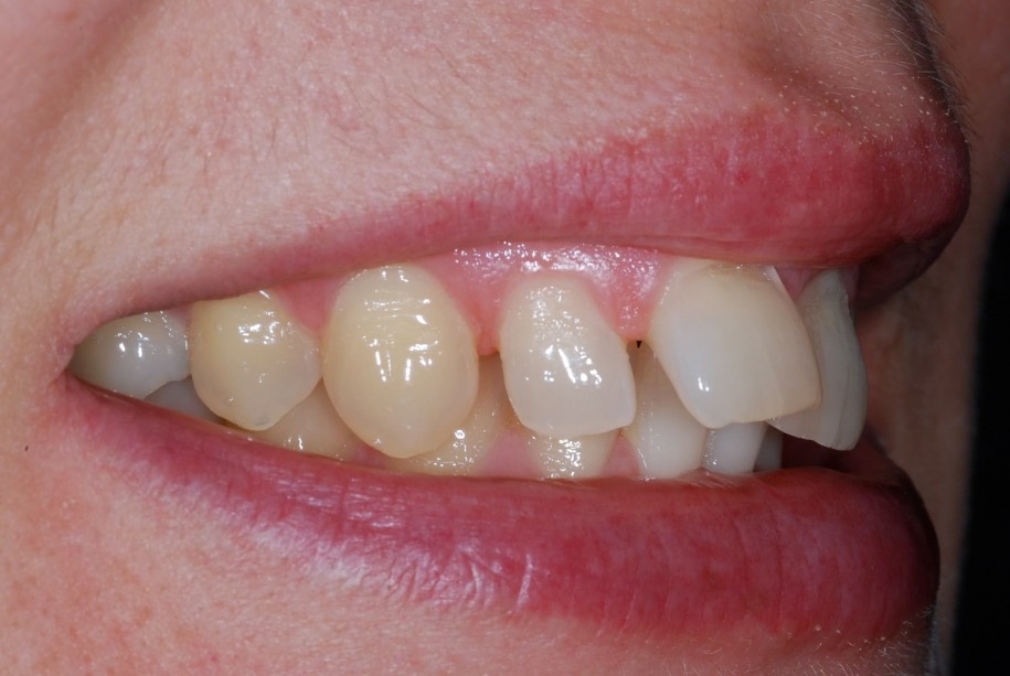 Inman aligner before, Wellington patient at Thorndon Dental