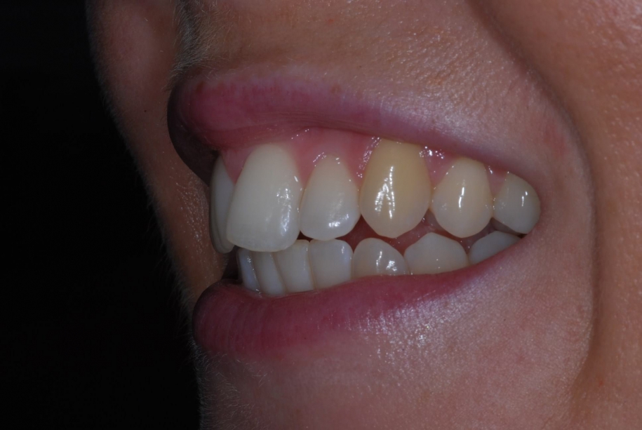 Inman aligner before, Wellington patient at Thorndon Dental