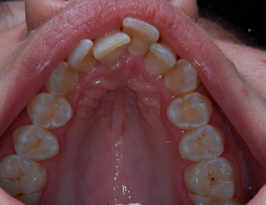 Inman aligner before, Wellington patient at Thorndon Dental