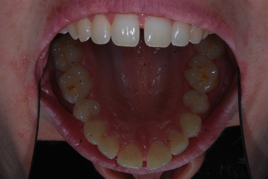 Inman aligner before, Wellington patient at Thorndon Dental