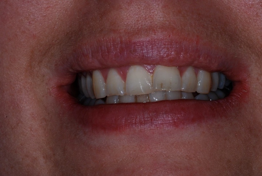 Inman aligner before, Wellington patient at Thorndon Dental