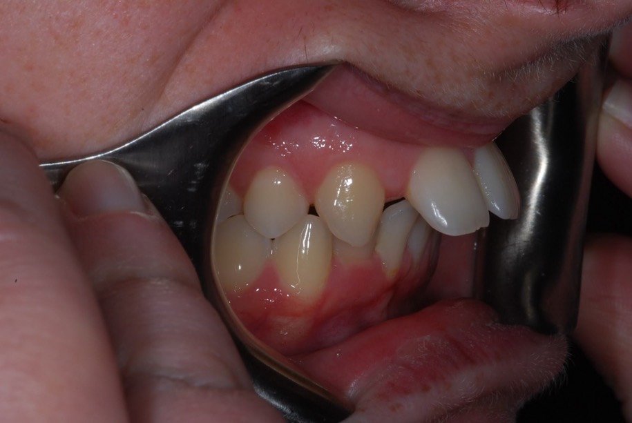 Inman aligner before, Wellington patient at Thorndon Dental